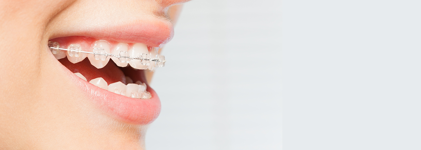 Fixed Braces Swindon | Clear Fixed Braces | Affordable Braces